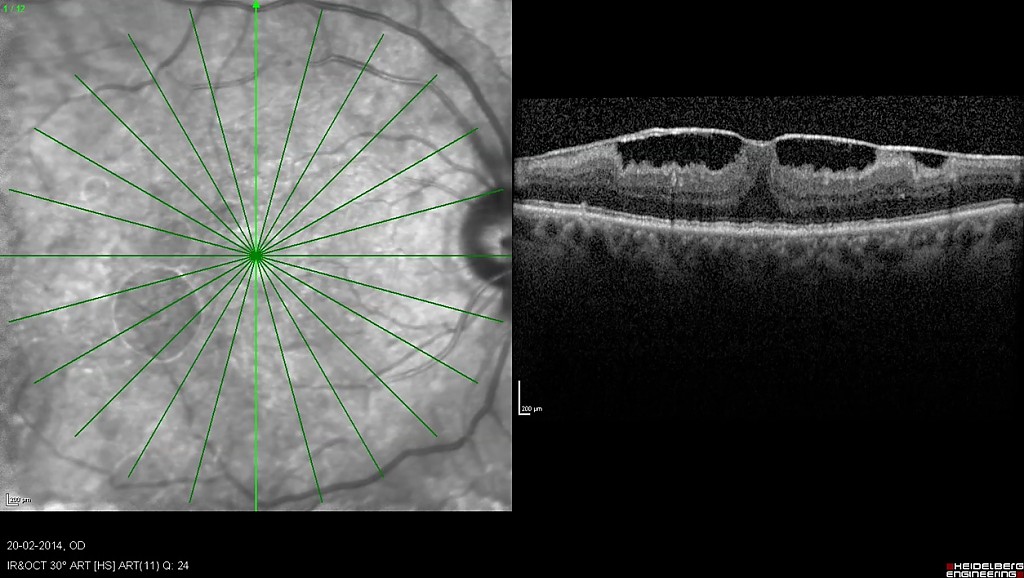 OCT Images preoperative